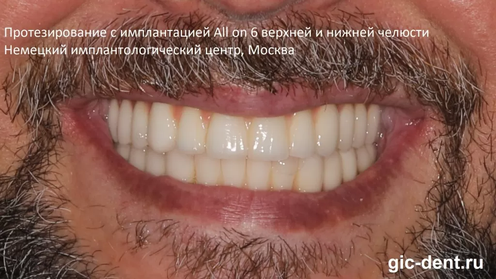 Пример качественной имплантации зубов all on 6 верхней и нижней челюсти – Немецкий имплантологический центр, Москва