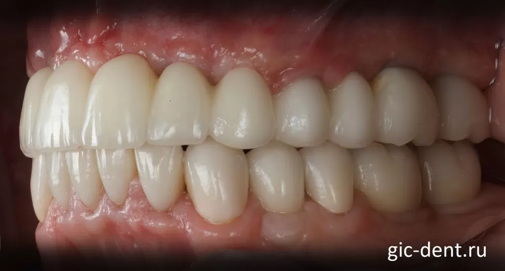 В некоторых моментах этого протезирования зубов даже трудно определить: где коронка на зуб, где на импланте, где вообще просто коронка подвешена. Немецкий имплантологический центр