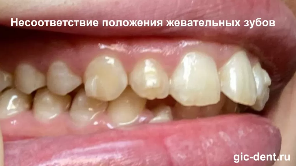 Сложность случая - максимальная, как как имеется еще несоответствие положения жевательных зубов