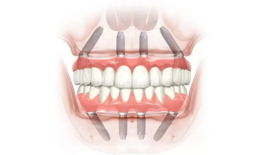 Концепция протезирования All-on-4 на четырех опорах в стоматологической клинике DrShorbatova