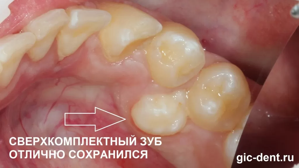 В данном случае этот зуб сыграл роль запасного варианта для пациента, послужил донором и принес огромную пользу, сыграв рол живого импланта зуба