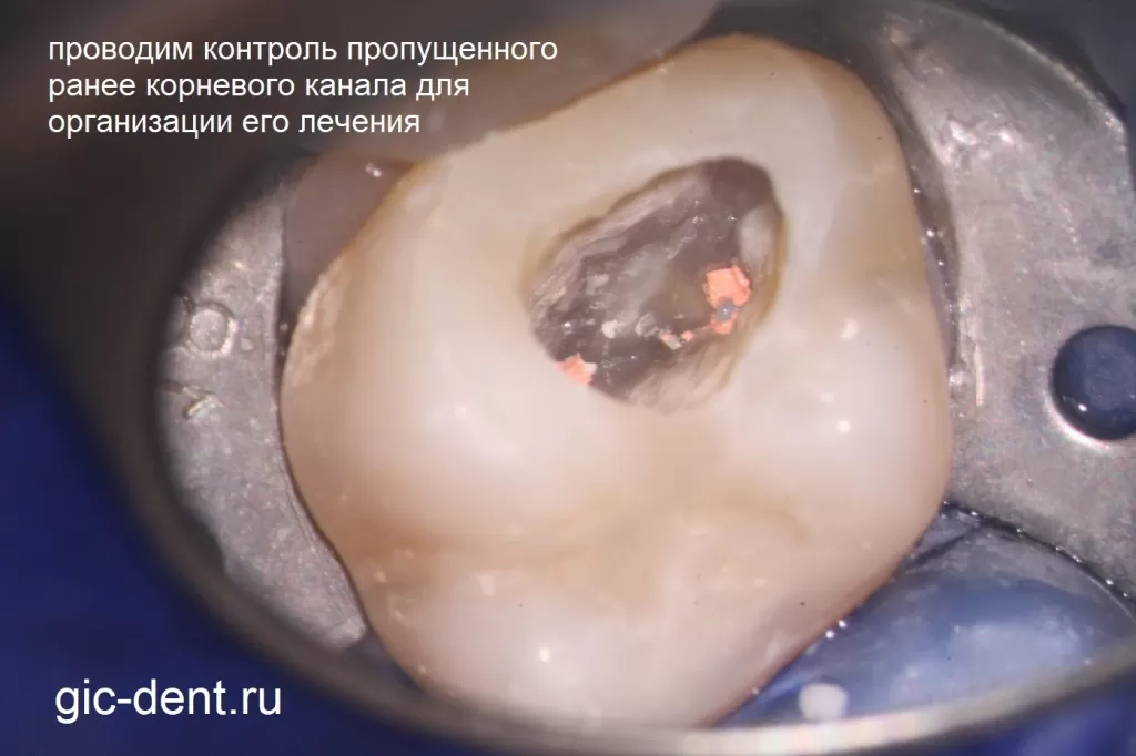 Вид полости зуба после удаления временной пломбы и контроля пропущенного канала до начала работы