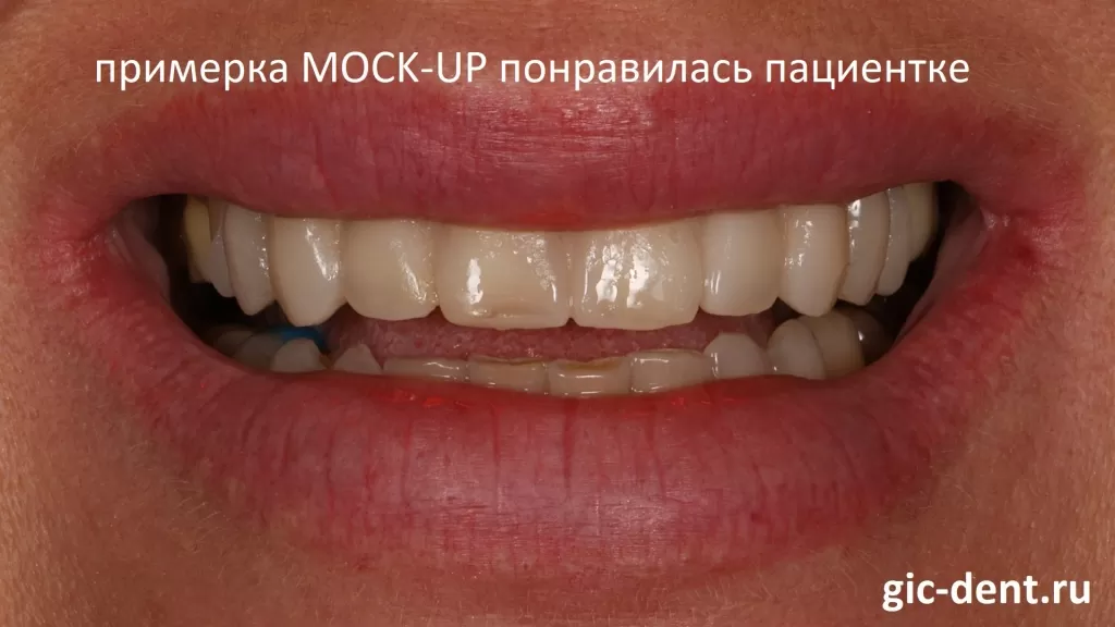 На этой фотографии вы видите примерку мокапа (mock-up): на зубы наносится композитный материал по форме будущих реставраций винирами
