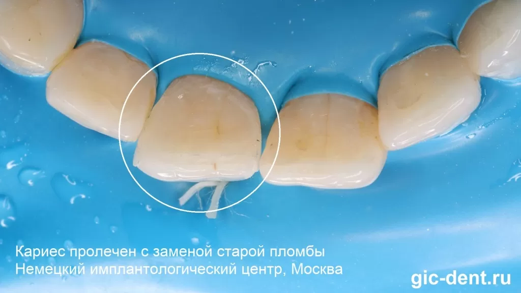 Зуб вылечен от кариеса, пломба заменена