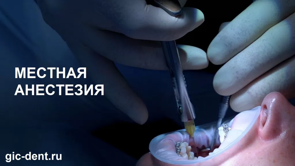 Местная анестезия, применяемая в клиниках Немецкого Имплантологического Центра - это инфильтрационная и проводниковая анестезия