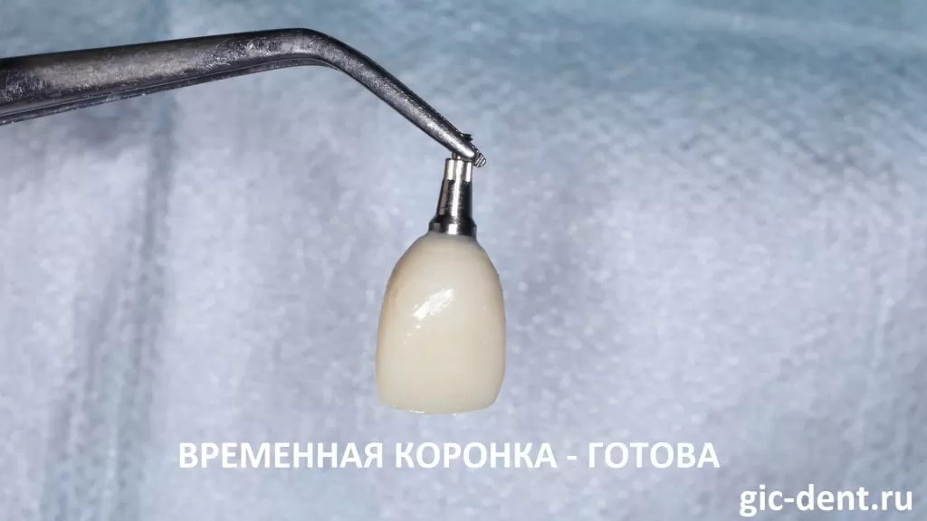 Вид временной коронки на передний верхний зуб, которая будет закреплена на имплантат