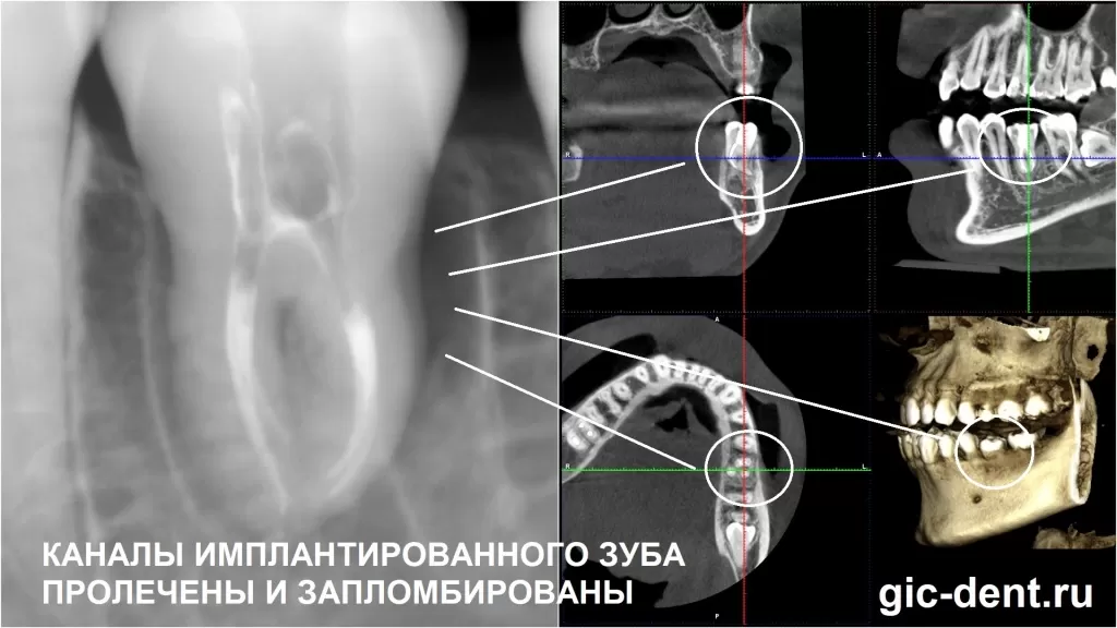 Результаты компьютерной томографии показывают отличную приживаемость пересаженного зуба.