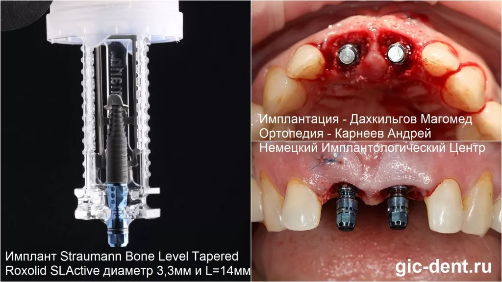 одномоментная имплантация зуба