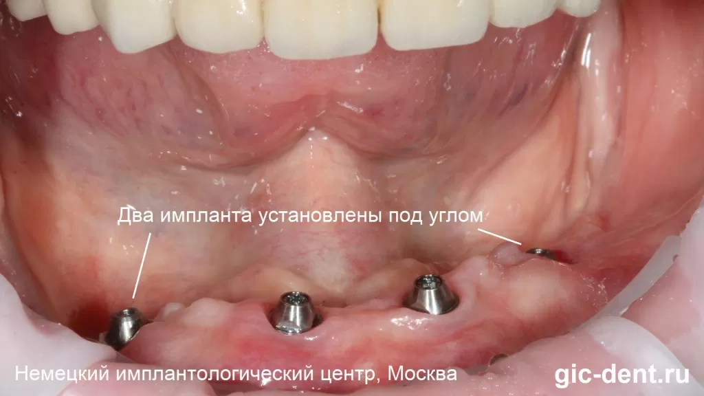 Для протезирования нижнец челюсти было принято решение поставить 4 импланта, 2 из них - под углом, чтобы обеспечить установку имплантов максимальной длины и подходящего диаметра