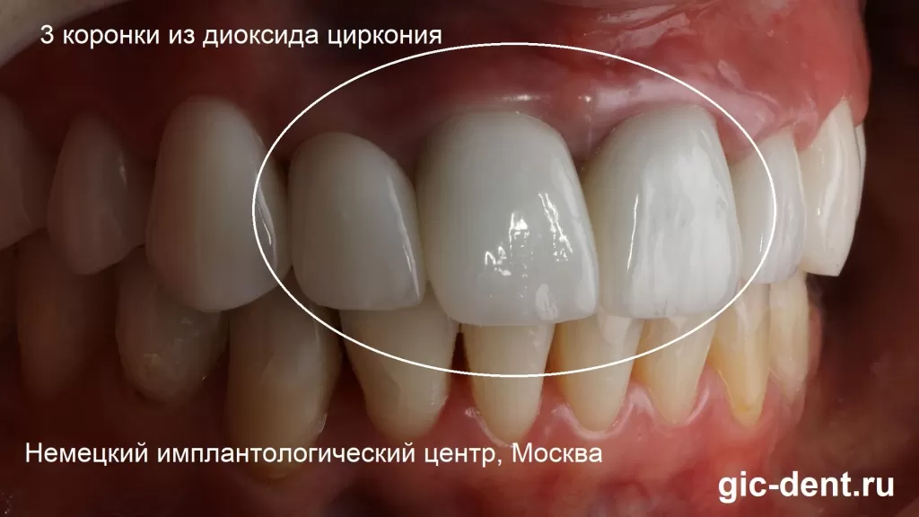 Три коронки из диоксида циркония решили проблему эстетики передних зубов. Немецкий имплантологический центр, Москва