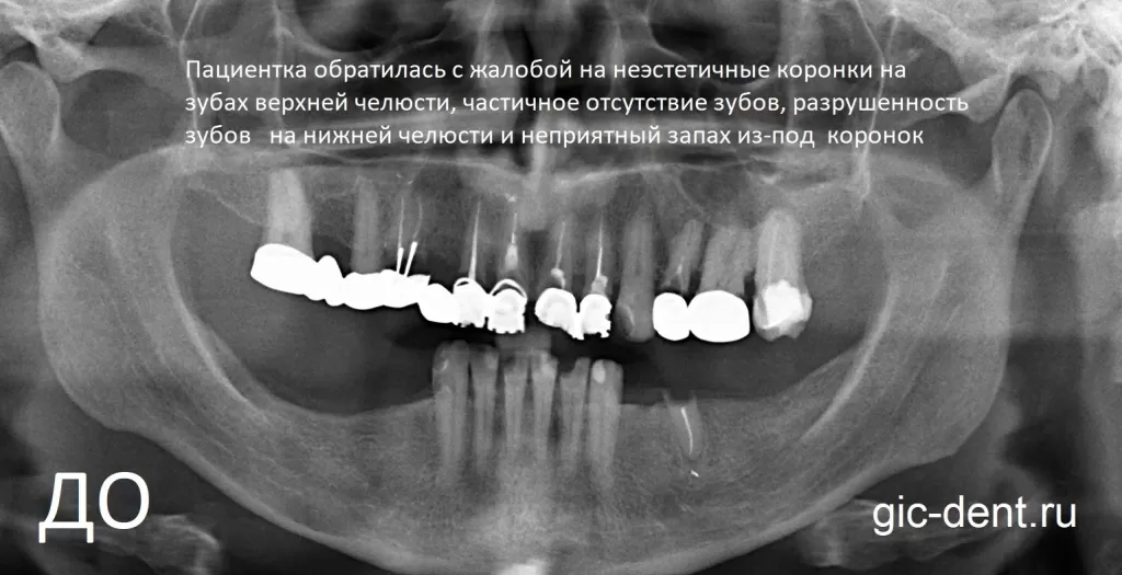 Проблема ортопедических конструкций: несостоятельные штамповано-паяные мостовидные протезы на зубах верхней челюсти