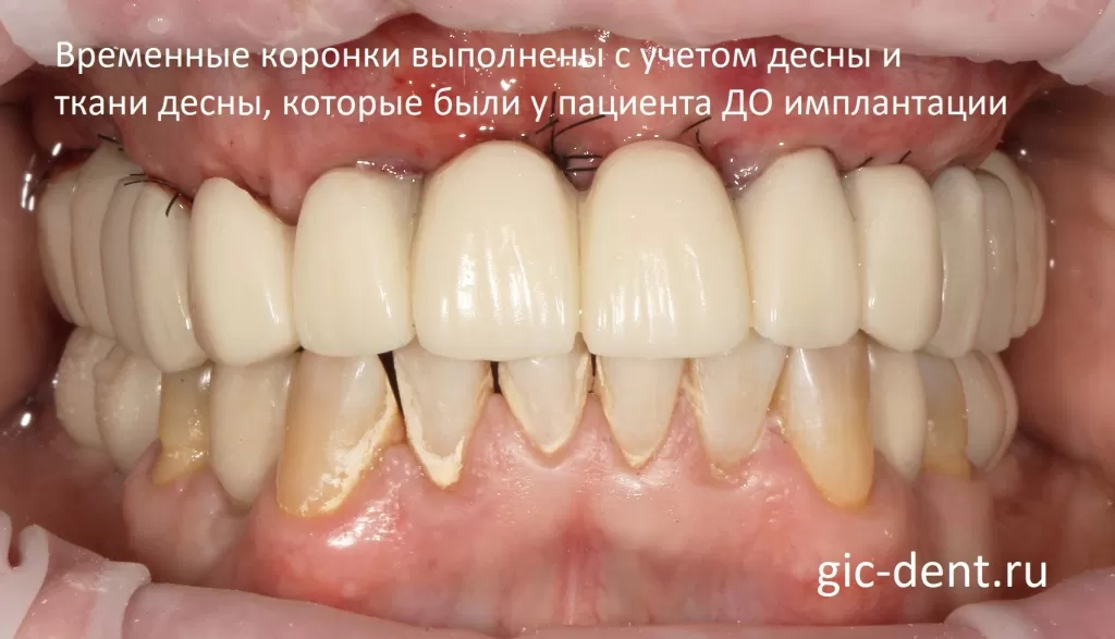 Зубные коронки, которые были сделаны пациенту, не идеальные пока, потому что были сделаны с учетом десны, состояния ткани десны, которые были ДО имплантации. Немецкий имплантологический центр.