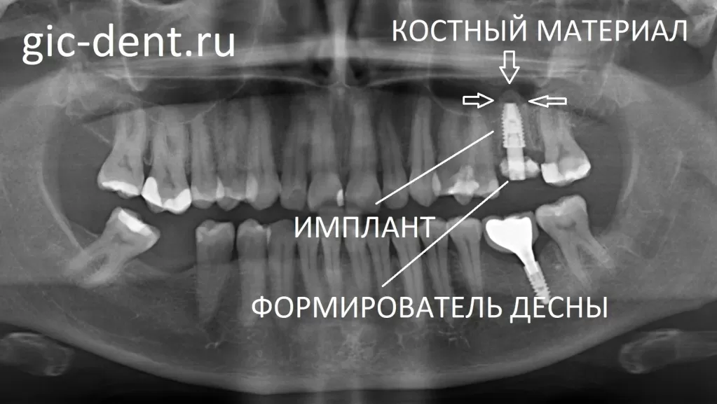На рентгене видим имплантат, костный материал и формирователь десны