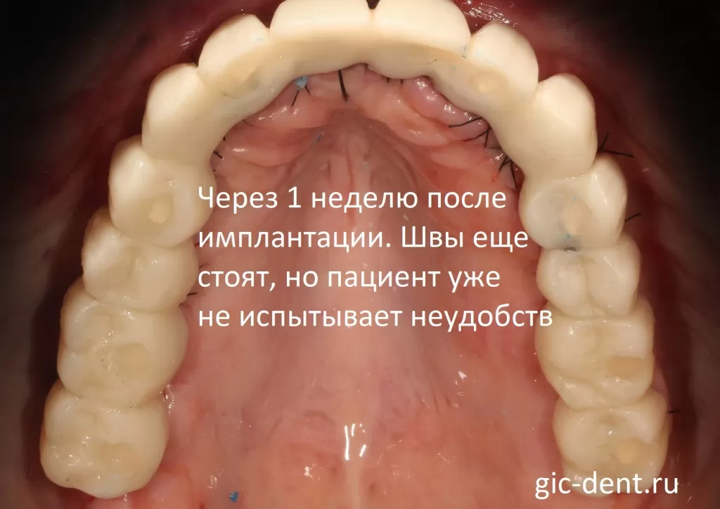 Временное протезирование зубов верхней челюсти. Пациент через неделю после имплантации уже не испытывал неудобств. Немецкий имплантологический центр