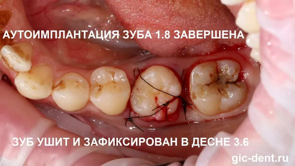 Искусственный зуб вынут, а на его место пересажен живой ретинированный зуб-восьмерка