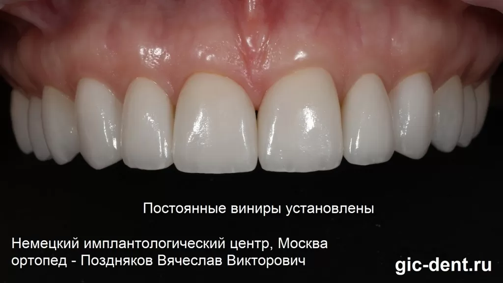 Виниры на зубах верхней челюсти установлены