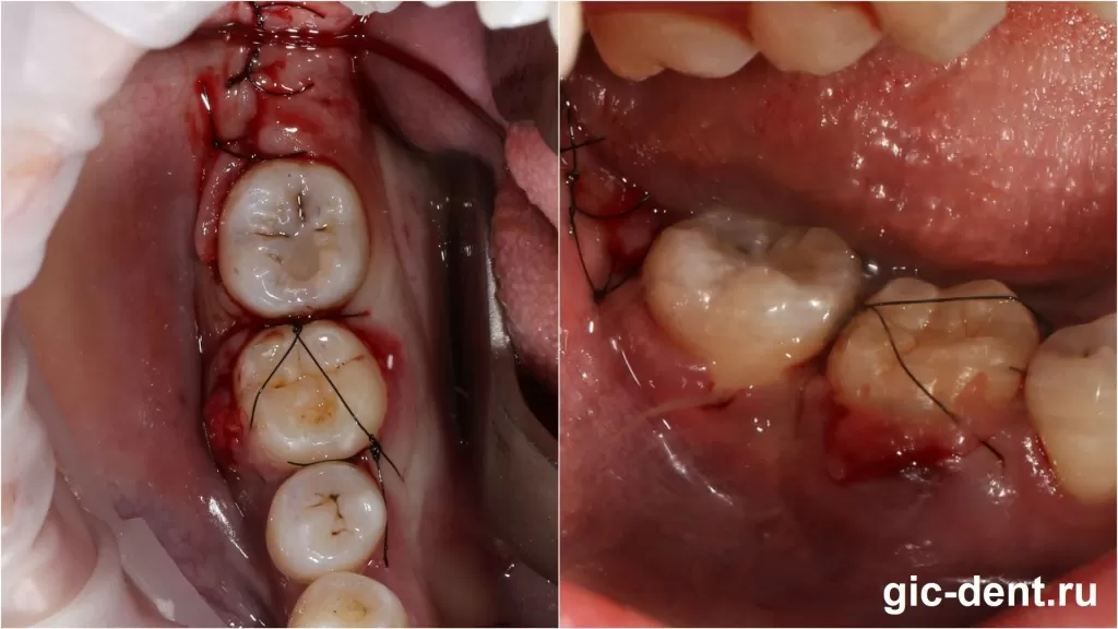 Пример операции аутотрансплантации зуба
