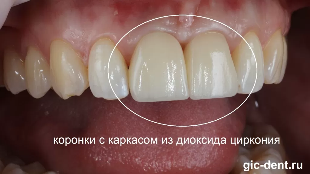 Вид передних зубов с постоянными коронками