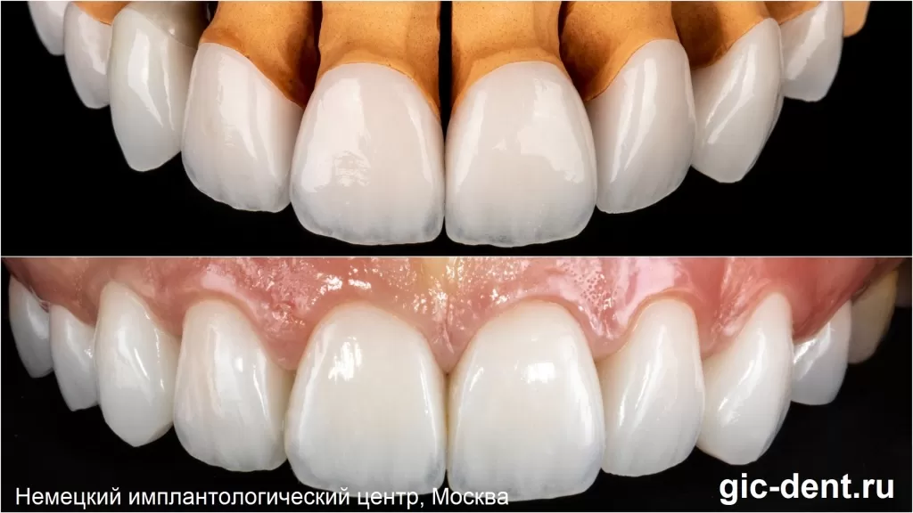 Вы можете сравнить эстетику на модели и на зубах пациентки. Немецкий имплантологический центр