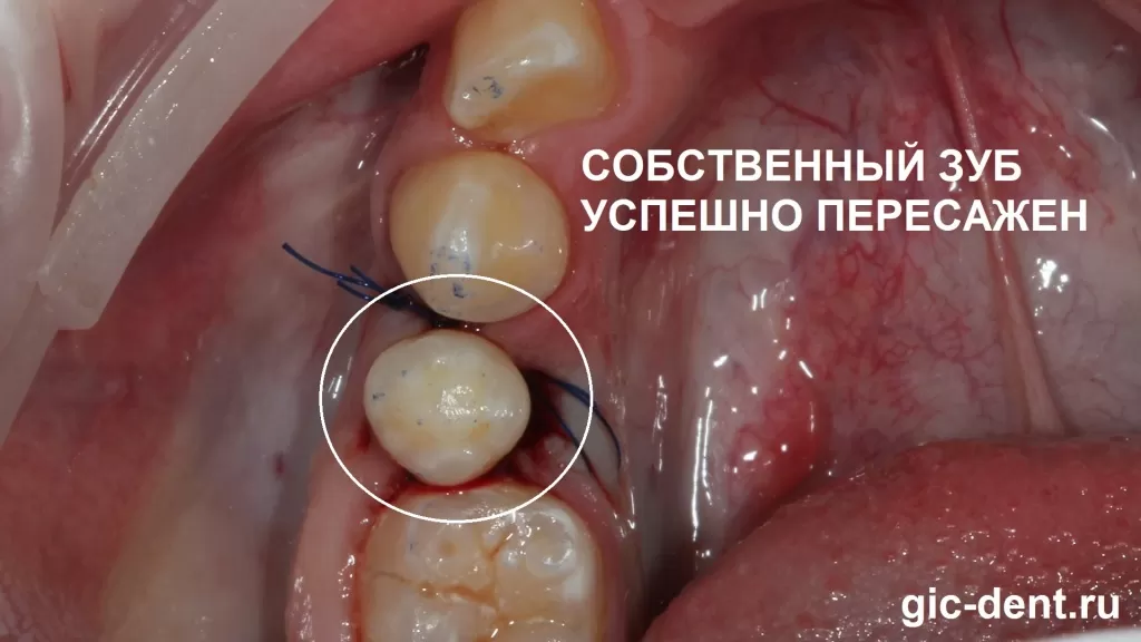 Удаленный зуб, имплантированный на место нижней пятерки