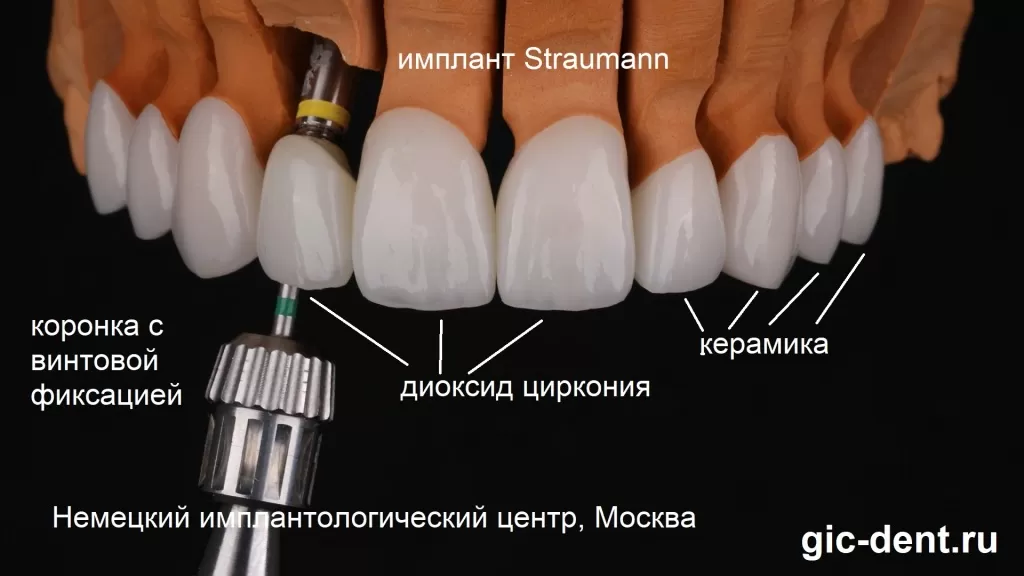 Циркониевая коронка на имплантате Straumann прикручивается винтом. Коронки на собственных зубах также выполнены на каркасе из диоксида циркония. Немецкий имплантологический центр
