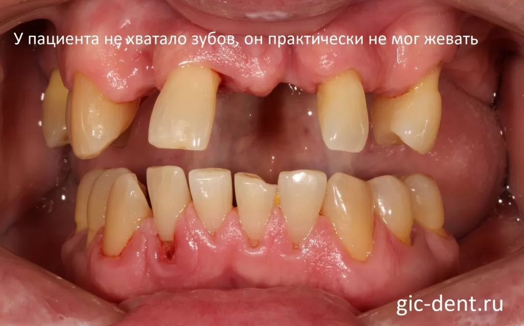 Зубы у пациента были удалены достаточно давно, вокруг зубов было воспаление, за счет этого произошли достаточно сильные изменения костной ткани
