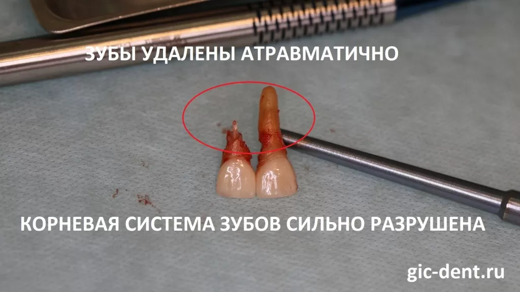 На фотографии отчетливо видно, что на обоих резцах имеется поражение: корневая часть зубов была разрушена, изъедена, и эти зубы невозможно было сохранить. Хирург Магомед Дахкильгов