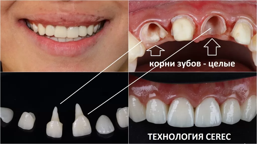 Если остался корень зуба, то очень хорошо себя зарекомендовала при восстановлении зуба технология CEREC