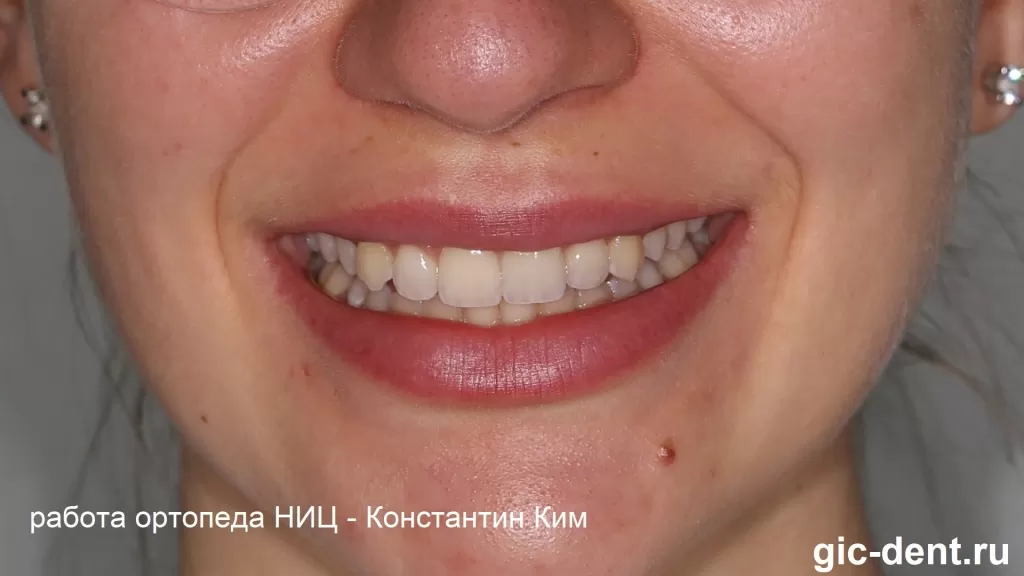 4 винира на передние верхние зубы установлены. Первая очаровательная улыбка их обладательницы - Виктории