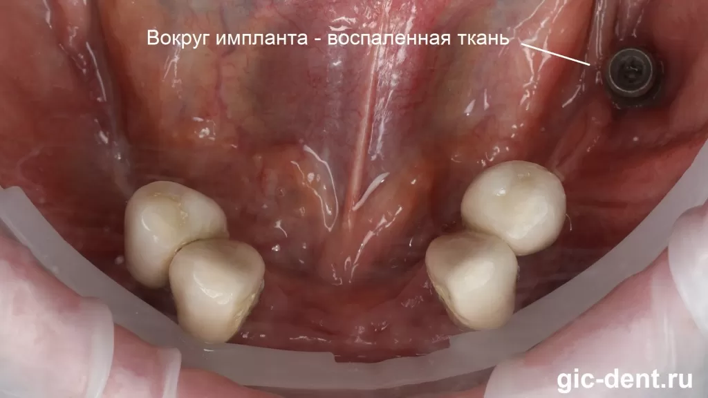 У пациента на нижней челюсти имелось всего 4 зуба, воспалительные процессы в области ранее установленных имплантов