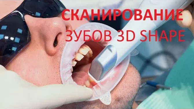 Интраоральное сканирование зубов сканером 3D Shape