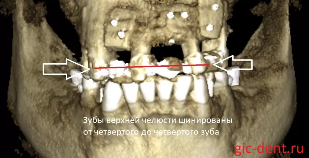 Зубы верхней челюсти надежно шинированы.Немецкий имплантологический центр