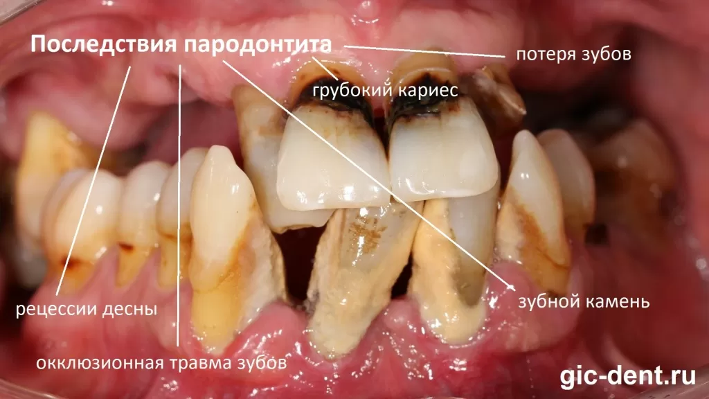 В первую очередь, серьезнейшая окклюзионная травма, которую вы можете наблюдать в виде буквально разбросанных под разными углами зубов