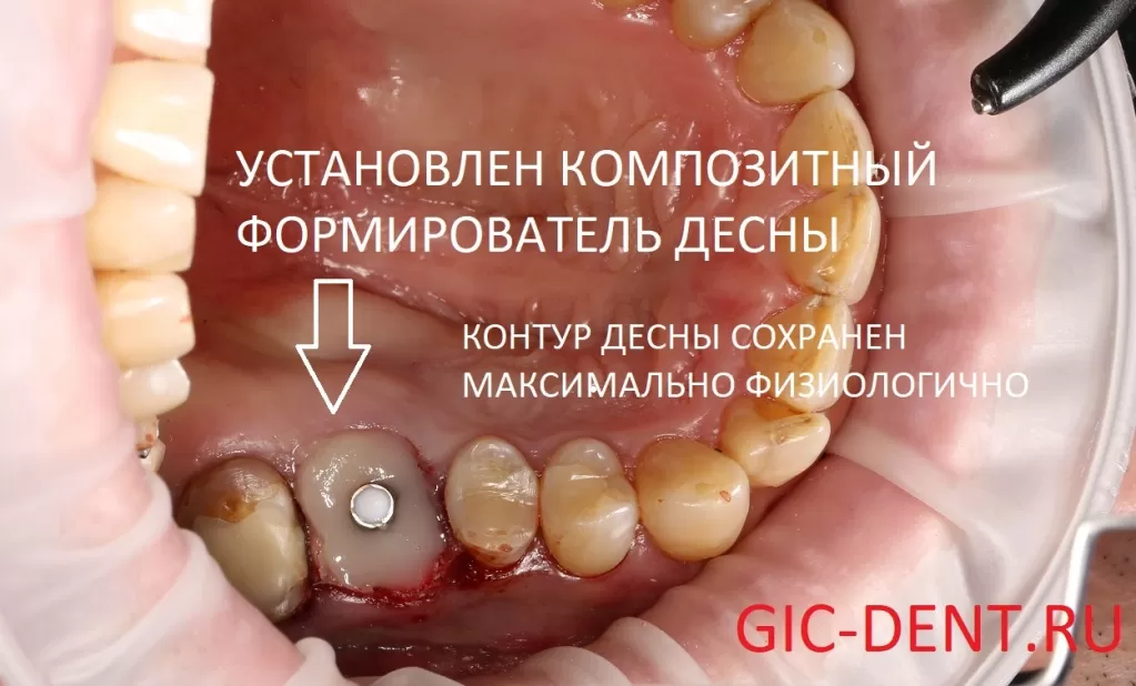 Индивидуализированный композитный формирователь десны. Имплантация зубов.