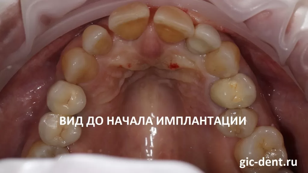 Фото до имплантации 4 передних верхних зубов. Имплантолог Колушев Глеб Валерьевич, Немецкий имплантологический центр