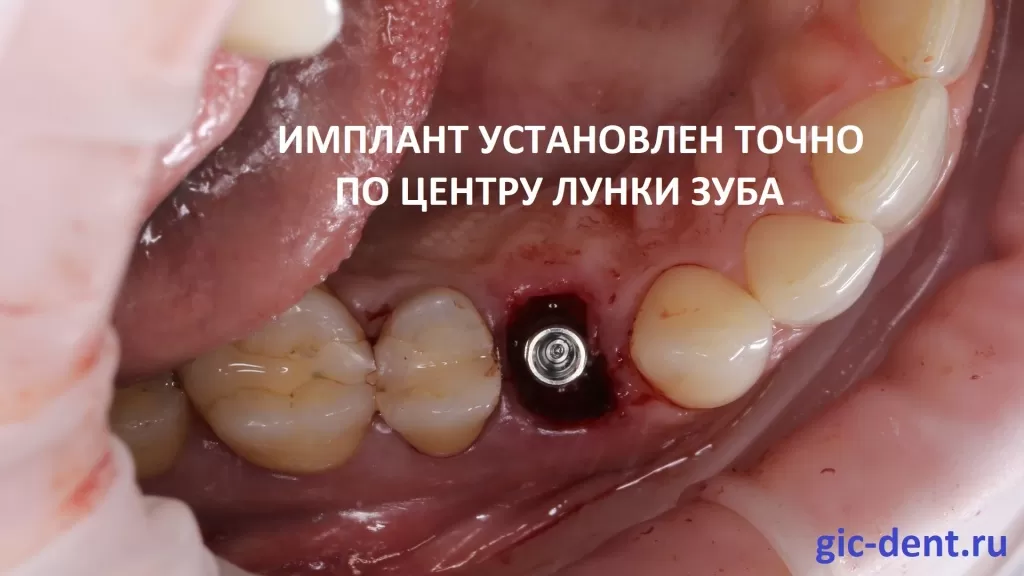 Имплант четко стоит по центру лунки зуба 1.4. Имплантацию проводит главный врач НИЦ Дахкильгов Магомед Уматгиреевич