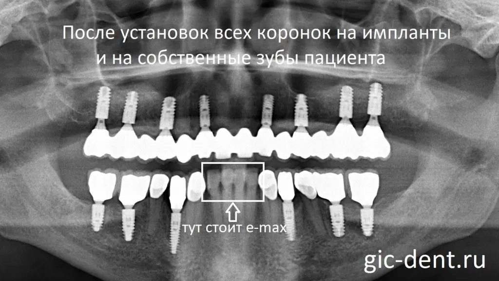 Контрольный снимок после установки всех коронок окончательно на импланты и на зубы
