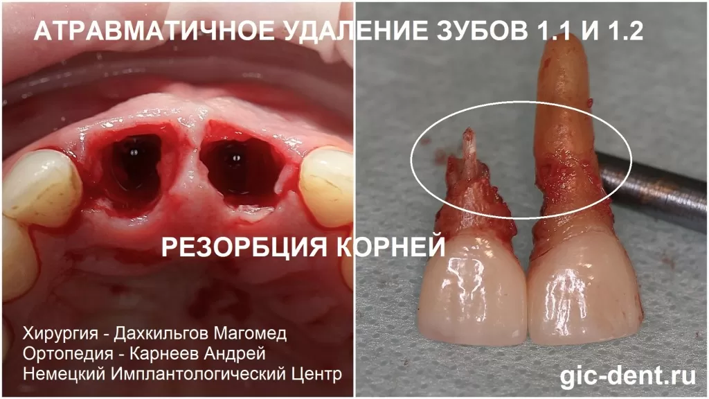 После атравматичного удаления зуба 11 и 21 видна значительная резорбция корня, что подтвердило невозможность консервативного лечения