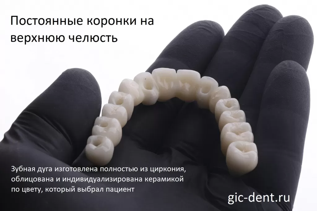 Зубная дуга выпилена полностью из циркония, облицована и индивидуализирована керамикой по цвету, который полностью согласован с пациентом. Немецкий имплантологический центр.