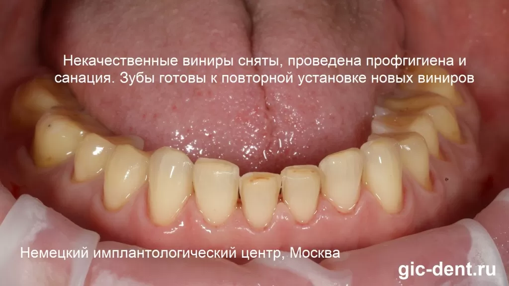 Нижние зубы очищены от старых виниров и проведена профгигиена зубов