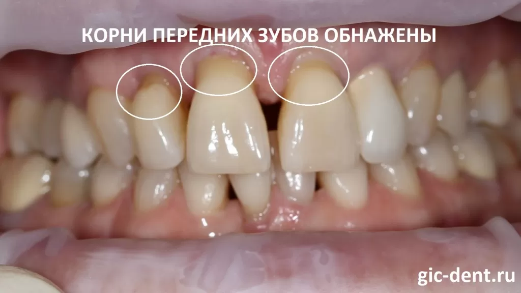Кроме увеличения подвижности передних зубов, нашу пациентку волновало то, что происходит обнажение корней передних зубов. Немецкий имплантологический центр. Ортопед Поздняков В.В.