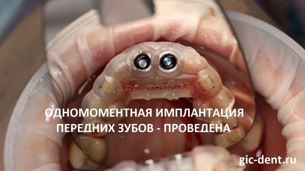 В область передних верхних зубов установлены импланты Straumann. Хирург Дахкильгов Магомед Уматгиреевич, Немецкий Имплантологический Центр