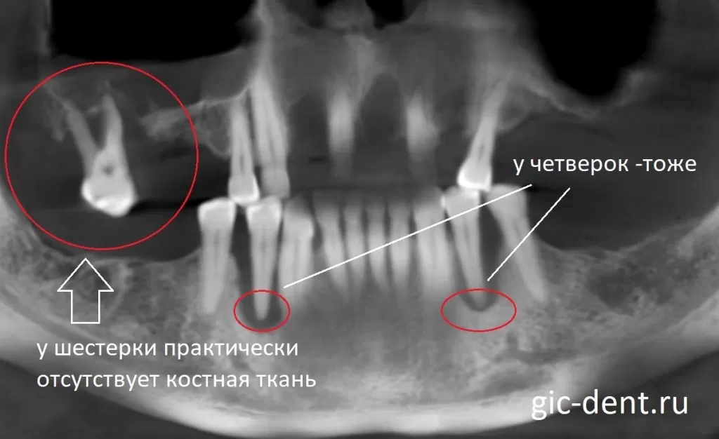 Рентгеновский снимок показал отсуствие костной ткани у ряда зубов. Немецкий имплантологический центр. 