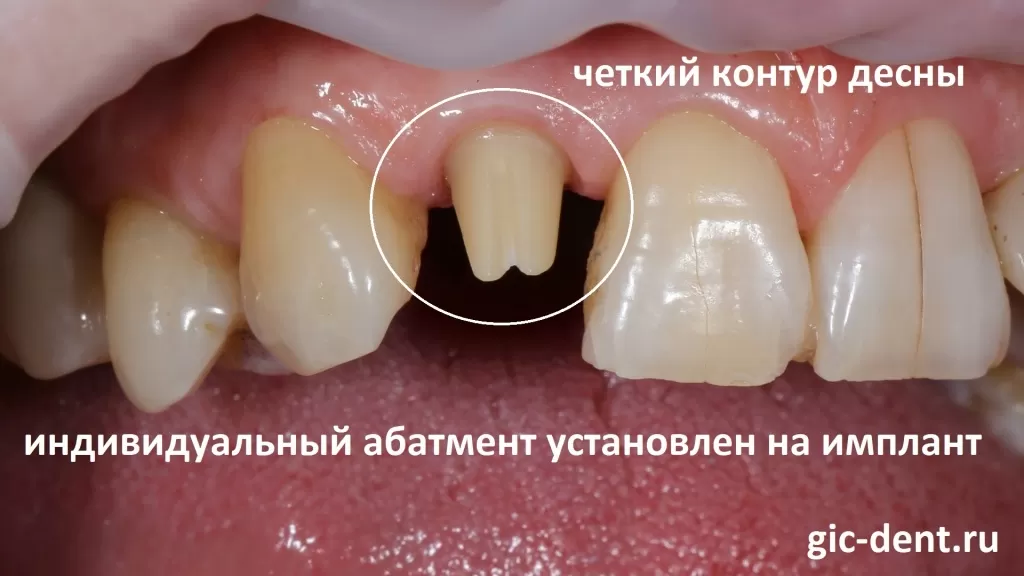 Итак, передний зуб был атравматично удален. Был установлен имплантат Nobel Parallel Conical Connection. Имплантация верхнего резца 1.2 прошла в плановом режиме