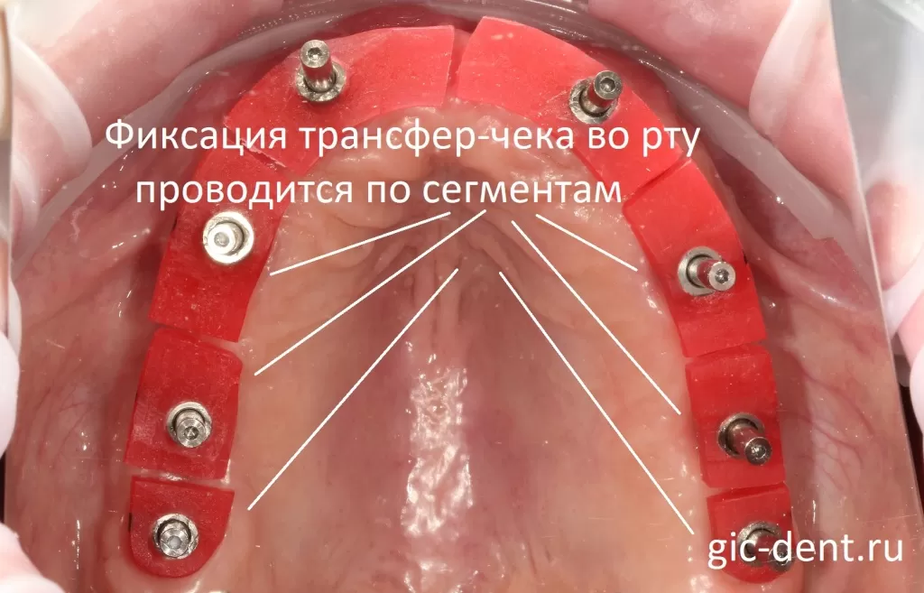Поставив конструкцию трансфер-чека во рту, вы уже можете видеть, насколько расходятся сегменты. Немецкий имплантологический центр