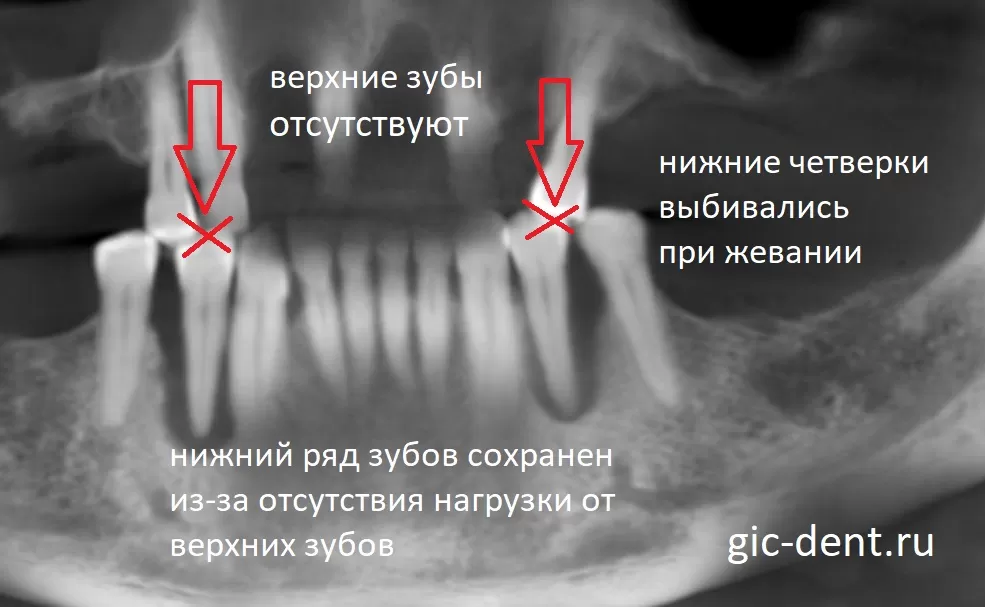Передние нижние зубы сохранены благодаря отсутствию верхних. А четверки нижние - выбиты. Имплантация в условиях сахарного диабета.