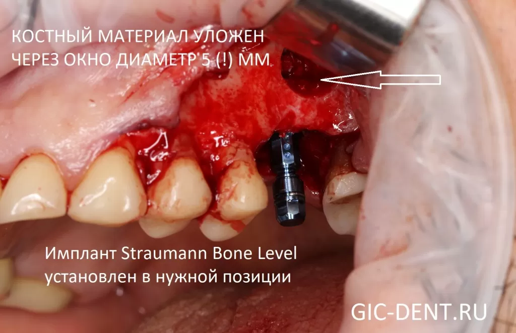 Имплантовод помогает имплантогу установить имплантат Straumann Bone Level в нужной позиции