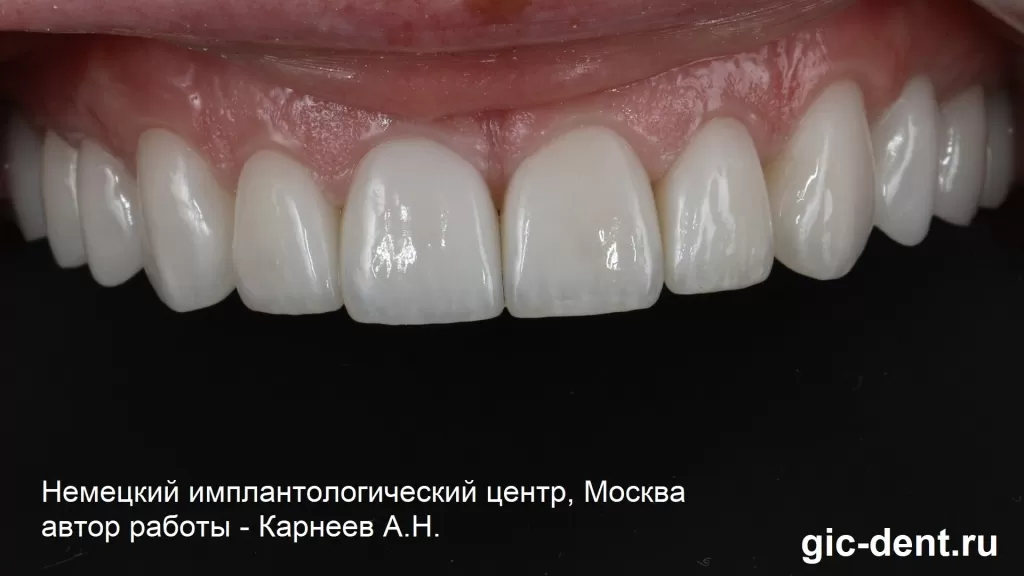 Через 3 месяца на собственные зубы верхней и нижней челюсти поэтапно были изготовлены постоянные цельнокерамические коронки
