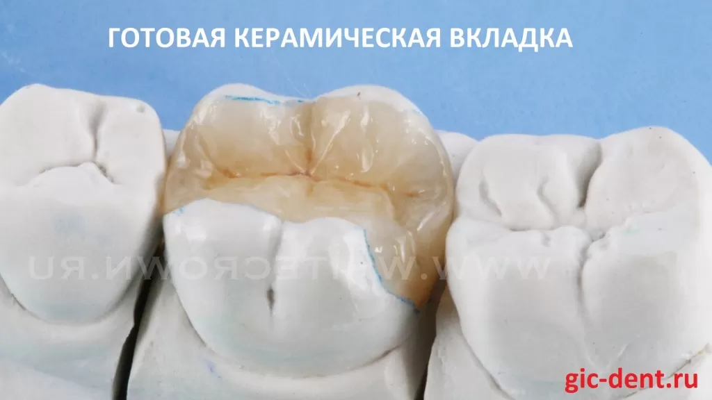 Так выглядит изготовленная керамическая вкладка на модели зуба. Автор - ортопед Карнеев Андрей Николаевич, Немецкий имплантологический центр