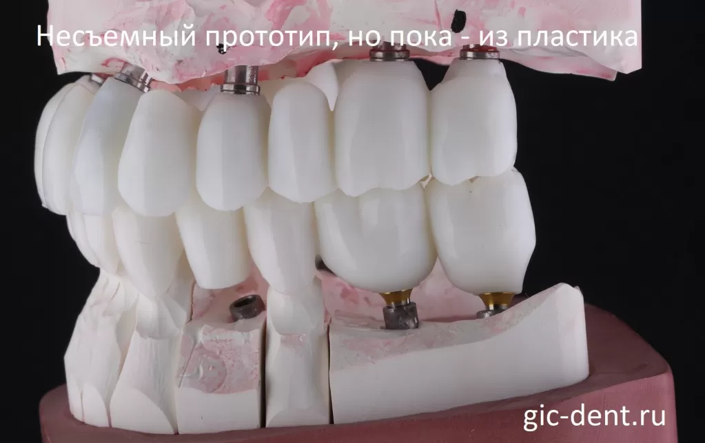 На снимке готовые коронки зубов, но они напечатаны еще из пластика. Немецкий имплантологический центр 